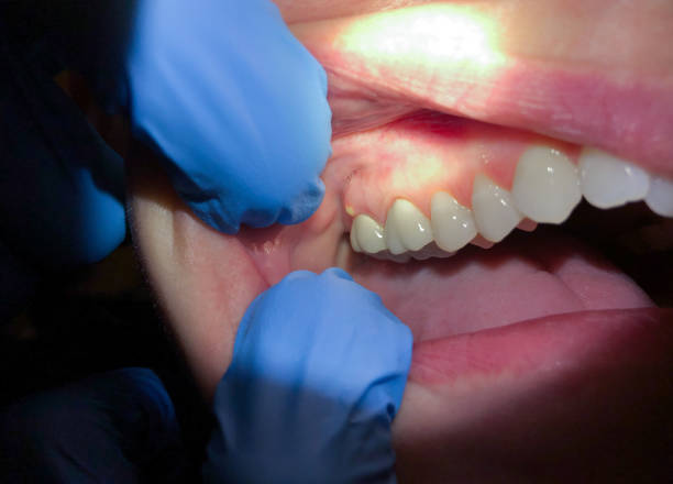 Best Emergency Care for Gum Disease in Bee Cave, TX